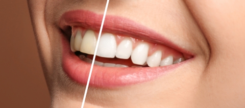 Teeth Whitening Orleans