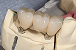 implant dental crown