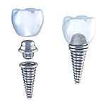 Orleans Implant Supported Crown