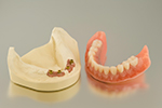 Orleans Implant Supported dentures