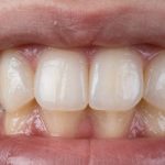 Close-up of a tooth with a porcelain inlay restoration.