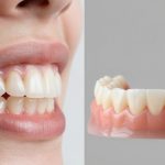 Dental implants and dentures comparison image.
