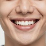 What Is Teeth Bonding vs Veneers? Which Option Is Better?
